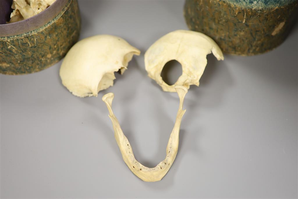 A Victorian disarticulated human skull in original tiered box